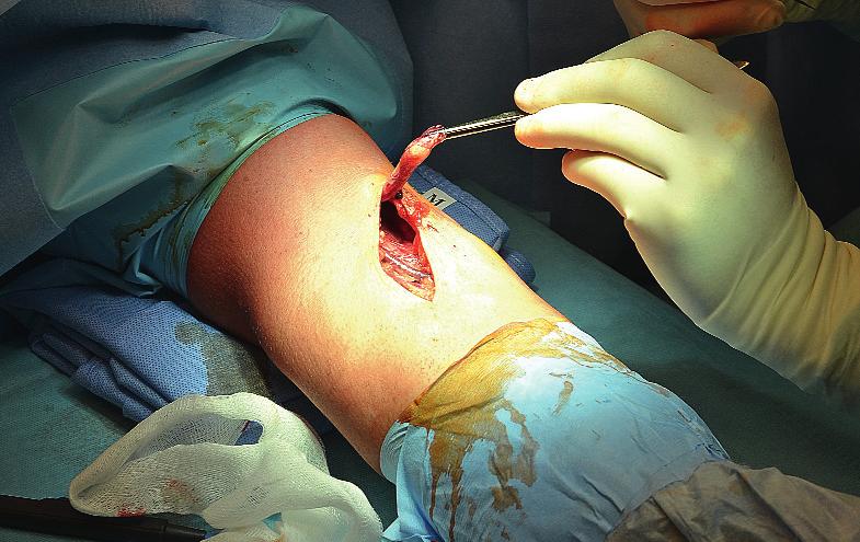 Výsledek operace s použitím kostní kotvičky. Patrná je dobrá tonizace reinzerované distální šlachy m. biceps brachii. V jednom případě bylo abrupční poranění subtotální.