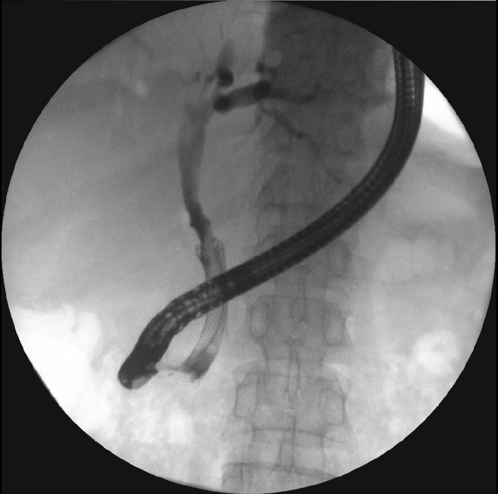 Závěr: Akutní cholangoitida. Funkční metalický stent. Odběr žluči na K + C. Prorůstání tumoru v distálním duodenu. Obrázek 10 ERCP 22. 9. 2010 Popis: Metalický stent ve žlučových cestách.