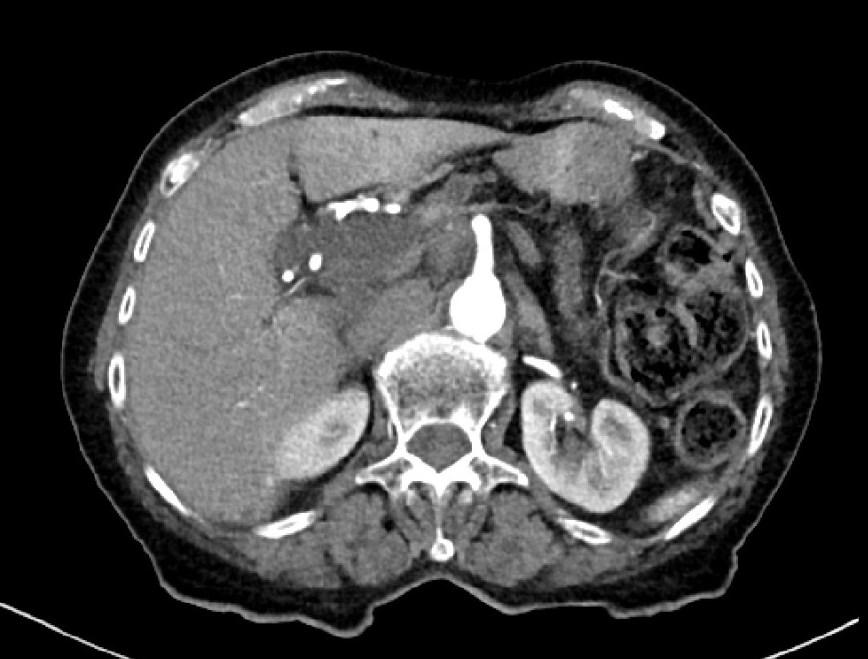 7.3 Kazuistika 3 Tumor žlučových cest Pohlaví: žena Věk: 85 let Anamnéza: Pacientka prodělala v dětství záškrt. V roce 1985 zánět žil levého lýtka. V roce 2001 oční operace z indikace šedého zákalu.