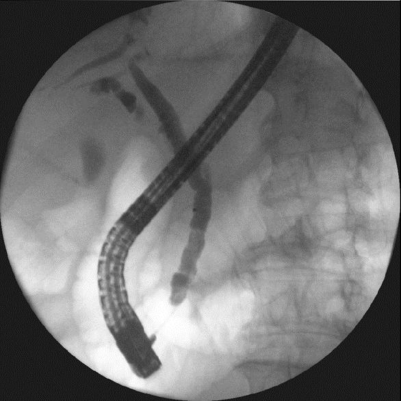 Obrázek 14 ERCP 1. 8. 2016 Popis: Naplněný dc. hepatocholedochus. Zdroj: NIS WinMedicalc FN Plzeň ERCP 3. 11. 2016 Vyšetření indikováno k výměně stávajícího stentu.