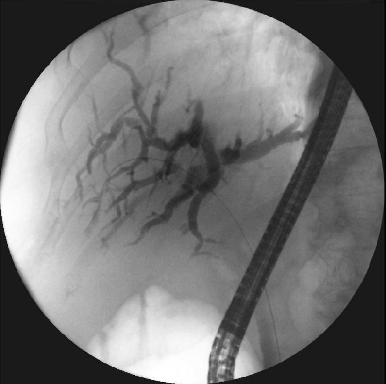 Obrázek 17 ERCP 6. 2. 2018 a) Popis: Stenóza dc. choledochus.