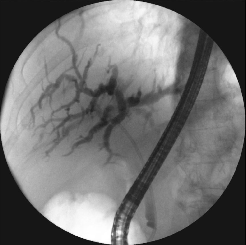 Obrázek 19 ERCP 6. 2. 2018 c) Popis: Naplněné intrahepatické ŽC. Zavedený plastikový stent. Zdroj: NIS WinMedicalc FN Plzeň Epikríza 9. 2. 2018 Laboratorně dochází postupně k velmi pozvolnému poklesu jaterních testů, současně však nadále mírně stoupají parametry zánětu, dále přítomna elevace TU markerů.