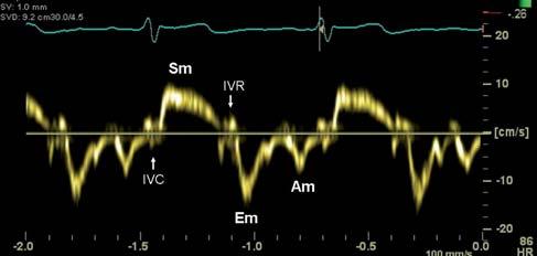 Obrázek 13 PW-TDE záznam normálního rychlostního profilu septálního okraje mitrálního anulu a parametrů v něm měřených; Em > 8 cm/s, poměr Em/Am > 1 PW-TDE pulsní tkáňová dopplerovská