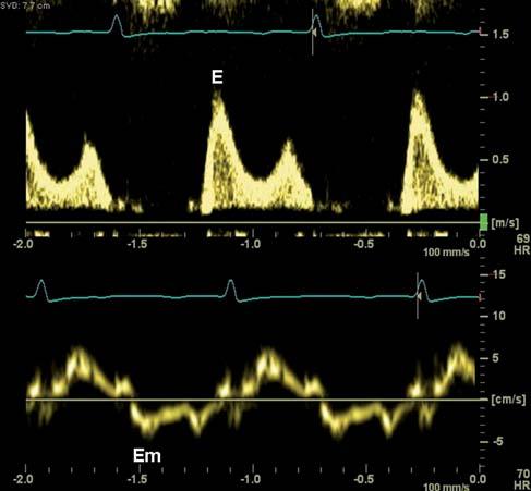 první pohled často zřetelně odlišují. Je ovšem nutné si uvědomit, že uvedené studie nebyly ve své metodice jednotné. Rychlost Em byla měřena na septálním či laterálním okraji anulu, popř.