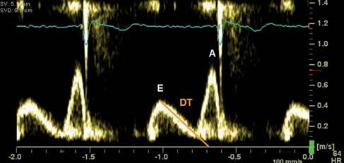 11 57 ± 13 75 ± 12 E/A 1,88 ± 0,45 1,53 ± 0,40 1,28 ± 0,25 0,96 ± 0,18 DT (ms) 142 ± 19 166 ± 14 181 ± 19 200 ± 29 IVRT (ms) 50 ± 9 67 ± 8 74 ± 7 87 ± 7 S (cm/s) 48 ± 10 44 ± 10 49 ± 8 52 ± 11 D