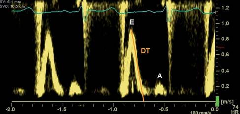 diastoly a mající typicky rychlost > 20 cm/s. Nazývá se vlnou L a je odrazem vysokých plnicích tlaků (mlap) v terénu těžké poruchy relaxace, obvykle zřetelně hypertrofické LK, (37,38) viz obrázek 5.