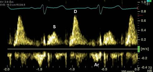 V pozdní diastole dochází při síňové kontrakci k malému reverznímu proudění zpět do plicních žil, které se projevuje negativní vlnou Ar.