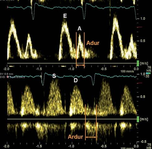 Obrázek 10 PW dopplerovský záznam rychlostních profilů mitrálního vtoku a toku v plicních žilách u jedince s normální EF a pseudonormalizací plnění LK; poměr E/A > 1, poměr S/D je sice > 1, rozdíl