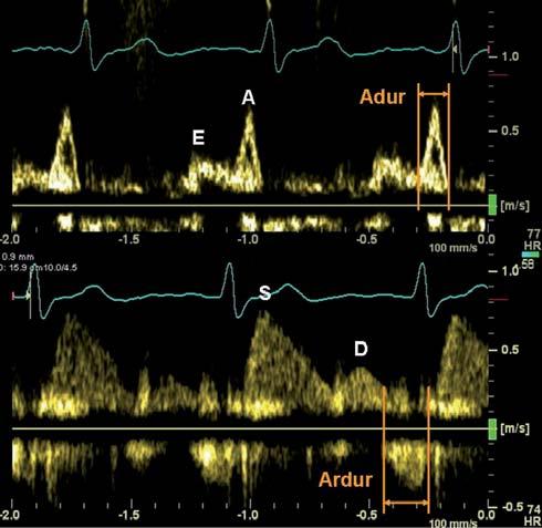 diastolického plnění LK, Adur doba trvání pozdně diastolického plnění LK, S rychlost proudění v plicní žíle v systole, D rychlost proudění v plicní žíle v časné diastole, Ardur doba trvání reverzního