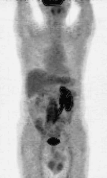 Kolektív: Využití pozitronové emisní tomografie ( 18 F-FDG PET) v diagnostice idiopatické retroperitoneální fibrózy 69 dělení okresní nemocnice 60letý muž s bolestmi dolní části zad, břicha a