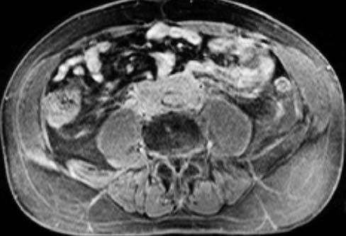 70 Kolektív: Využití pozitronové emisní tomografie ( 18 F-FDG PET) v diagnostice idiopatické retroperitoneální fibrózy Obr. 3.