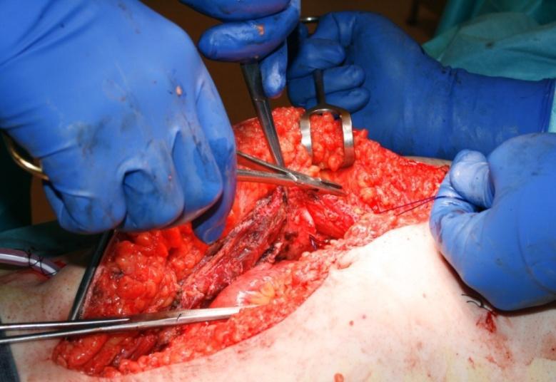 Kontaminace platiny na operačním sále po HIPEC cisplatina pg/cm 2 Operační sál MOÚ - HIPEC (limit 12pg/cm 2 ) podlaha pod nádobou s tampony 1 (krev) 4.97 podlaha u operatéra 1 (krev) 0.