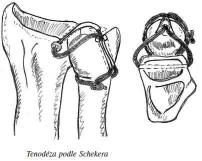 Příloha č. 8 Tenodéza (Zdroj: http://www.achot.cz/detail.