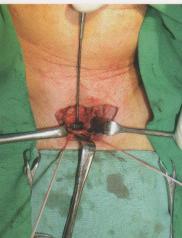 2.1.1 Chirurgická tracheostomie - provedení na operačním sále v
