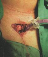 12 Tracheostomie - průběh operace (otevření průdušnice a zavedení