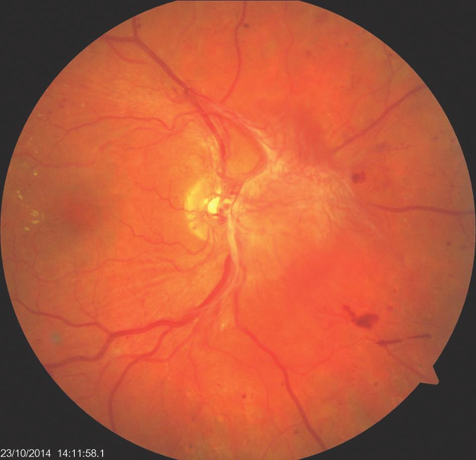 13 Nález makuly na OCT 3 měsíce po operaci: ústup edému, úprava linearity retinálních vrstev Kazuistika proliferativní diabetická retinopatie s diabetickým makulárním edémem Muž ve věku 44 let byl