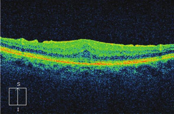 Pacient byl odeslán na naši kliniku k řešení proliferativní diabetické retinopatie na pravém oku. Panretinální fotokoagulace nebyla doposud provedena (obr. 13).