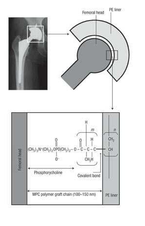 MPC povlaky MPC ( 2-methacryloyloxyethyl phosphorylcholine polymer) polymer. Stal se základem long-lasting umělého kloubu.