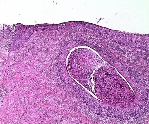 Bioptické vyšetření zjištěné prekancerózy a následné sledování Následné sledování