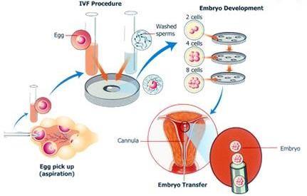 spermií může být manžel, tzv. AIH (artificial insemination from husband), nebo dárce, tzv. AID (arteficial insemination from donor). 2. IVF ET in vitro fertilizace a embryotransfer.