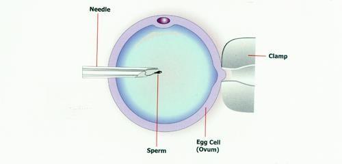 Obrázek 2: Intracytoplazmatická injekce spermie, při které je spermie vpravena přímo do vajíčka (URL 2). 6.