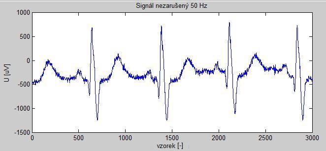 Hz brumem 3: Signál EKG bez