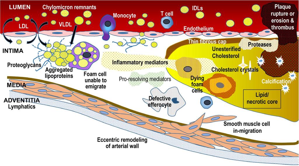 Zásadní je retence lipoproteinů v subendoteliálním prostoru Eradicating the Burden of Atherosclerotic Cardiovascular