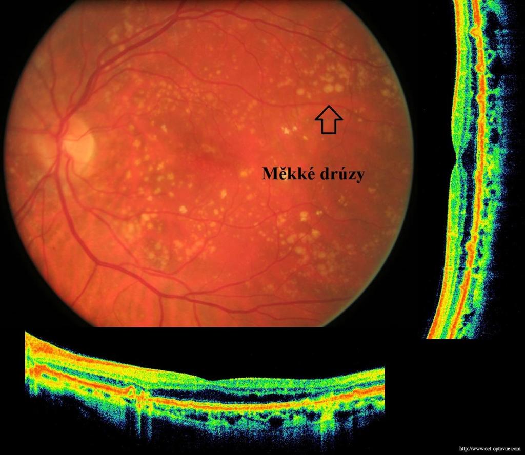 Měkké drúzy neostře ohraničená ložiska na sítnici, která jsou větší než tvrdé drúzy a mohou způsobovat zkreslení obrazu dopadajícího na sítnici (metamorfopsie). [4] Obr.