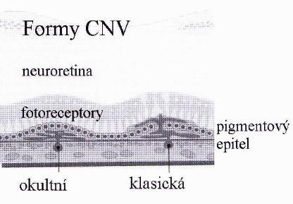 lokalizace nebo také dle provedené fluorescenční angiografie na okultní a klasickou formu CNV. Prorůstání CNV mezi RPE a živnatku je typické pro okultní formu.