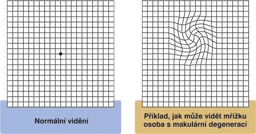 i na druhém oku. Při použití Yannuzziho tabulky může pacient zakreslit místa, kde mu linie mizí a tím i označí pozici skotomů v zorném poli.