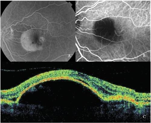 Pro správnou diagnostiku nestačí provést pouze indocyaniovou angiografii, vždy je třeba spojit výsledky z biomikroskopického vyšetření fundu, FA, ICGA a optické koherentní tomografie, které se budeme