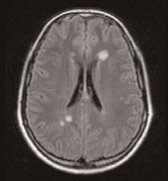 Z klinick ch pokusû s interferonem beta z posledních let jednoznaãnû vyplynulo, Ïe optimální dobu k zahájení imunomodulaãní léãby pfiedstavuje jiï první ataka neurologick ch pfiíznakû, kde je dle