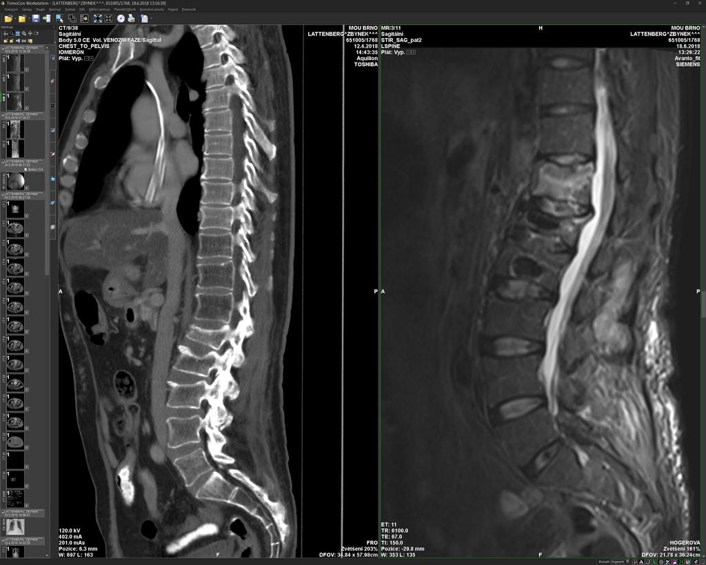 Intervenční radiologie/ Intervenční onkologie Kurativní zákroky Paliativní