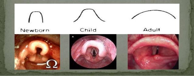 Velká epiglotis tvaru písmene omega Dýchací cesty Paedriatic