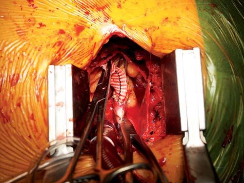 Horní ministernotomie s sebou přináší limitovaný přístup k ascendentní aortě a řešení komplikací anastomózy výtokového graftu může být rovněž technicky náročné.