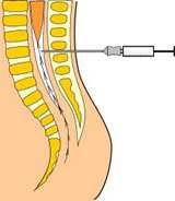 Příloha 10. Ilustrace epidurální analgezie Zdroj: http://www.wikiskripta.eu/index.
