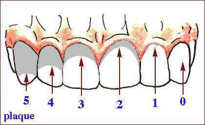 Hygienické indexy (indexy hodnotící akumulaci plaku) Gingivální indexy (indexy hodnotící stupeň zánětu gingivy) Parodontální indexy (indexy hodnotící stupeň destrukce parodontu a potřebu parodontální