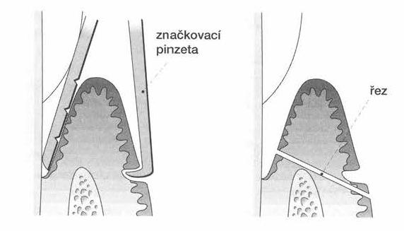 Obrázek 23: Vedení incizí při gingivektomii - Zevní gingivektomie [Zdroj: 5]. 4.3. Gingivální recesy Techniky krytí gingiválních recesů se začaly rozvíjet v polovině osmdesátých let, kdy se pro krytí gingiválních recesů začaly používat pojivové štěpy.