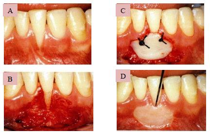 4.3.1. Volný epiteliální štěp Chirurgická metoda zahrnující doplnění gingivální tkáně pomocí tkáňového štěpu. Relativně jednoduchý výkon, používaný v hojné míře.