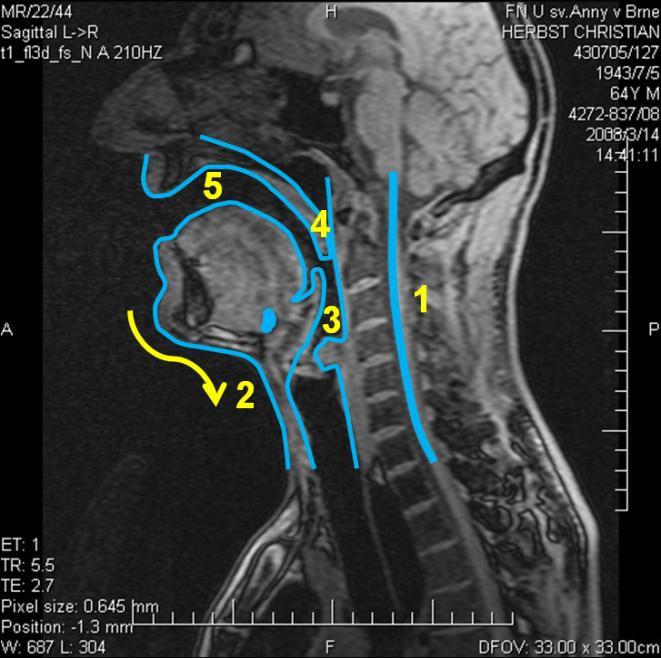 5.2 Subjekt 2 5.2.1 Vokál [a:] Obrázek 25 MRI subjektu 2, vokál *a:+, vlevo nepěvecky, vpravo pěvecky - subjekt 2 je zachycen jak při technice neoperní, tak operní.