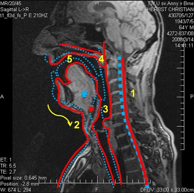 5.2.2 Vokál [e:] Obrázek 26 MRI subjektu 2, vokál *e:+, vlevo nepěvecky, vpravo pěvecky - subjekt 2 je zachycen jak při technice neoperní, tak operní.