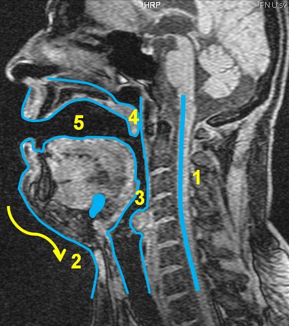 5.3 Subjekt 3 5.3.1 Vokál [a:] Obrázek 27 MRI subjektu 3, vokál *a:+, vlevo nepěvecky, vpravo pěvecky - subjekt 3 je zachycen jak při technice neoperní, tak operní.