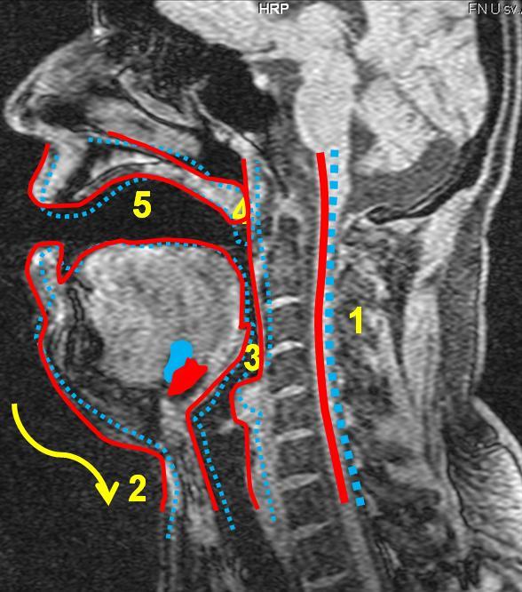 U subjektu 3 došlo k mírnému ventrálnímu prohnutí páteře (1), současně však i k mírnému záklonu hlavy. U brady (2) nastala mírná retroflexe, spíše se posunula kaudálním směrem.