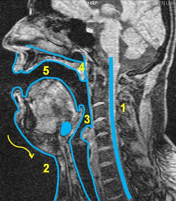 5.3.2 Vokál [e:] Obrázek 28 MRI subjektu 3, vokál *e:+, vlevo nepěvecky, vpravo pěvecky - subjekt 3 je zachycen jak při technice neoperní, tak operní.