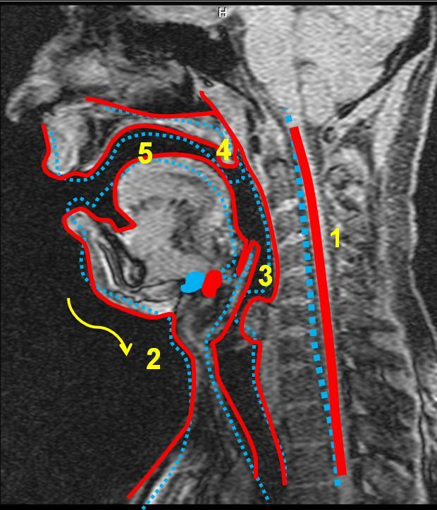 5.4.2 Vokál [e:] Obrázek 30 MRI subjektu 4, vokál *e:+, vlevo nepěvecky, vpravo pěvecky - subjekt 3 je zachycen jak při technice neoperní, tak operní.