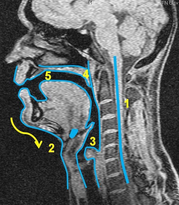 5.5 Subjekt 5 5.5.1 Vokál [a:] Obrázek 31 MRI subjektu 5, vokál *a:+, vlevo nepěvecky, vpravo pěvecky - subjekt 3 je zachycen jak při technice neoperní, tak operní.