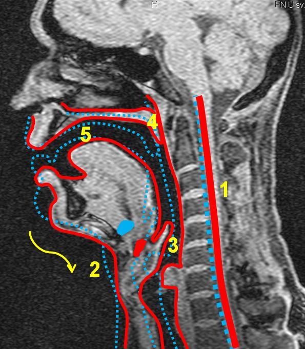 5.5.2 Vokál [e:] Obrázek 32 MRI subjektu 5, vokál *e:+, vlevo nepěvecky, vpravo pěvecky - subjekt 3 je zachycen jak při technice neoperní, tak operní.