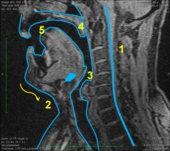 5.6.2 Vokál [e:] Obrázek 34 MRI subjektu 6, vokál *e:+, vlevo nepěvecky, vpravo pěvecky - subjekt 3 je zachycen jak při technice neoperní, tak operní.