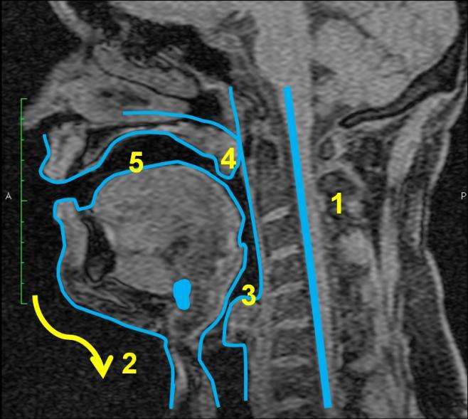 5.7 Subjekt 7 5.7.1 Vokál [a:] Obrázek 35 MRI subjektu 7, vokál *a:+, vlevo nepěvecky, vpravo pěvecky - subjekt 3 je zachycen jak při technice neoperní, tak operní.