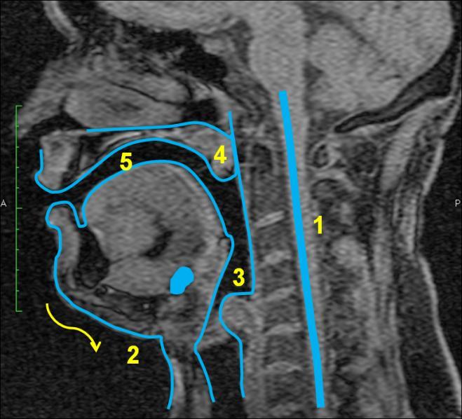 5.7.2 Vokál [e:] Obrázek 36 MRI subjektu 7, vokál *e:+, vlevo nepěvecky, vpravo pěvecky - subjekt 3 je zachycen jak při technice neoperní, tak operní.